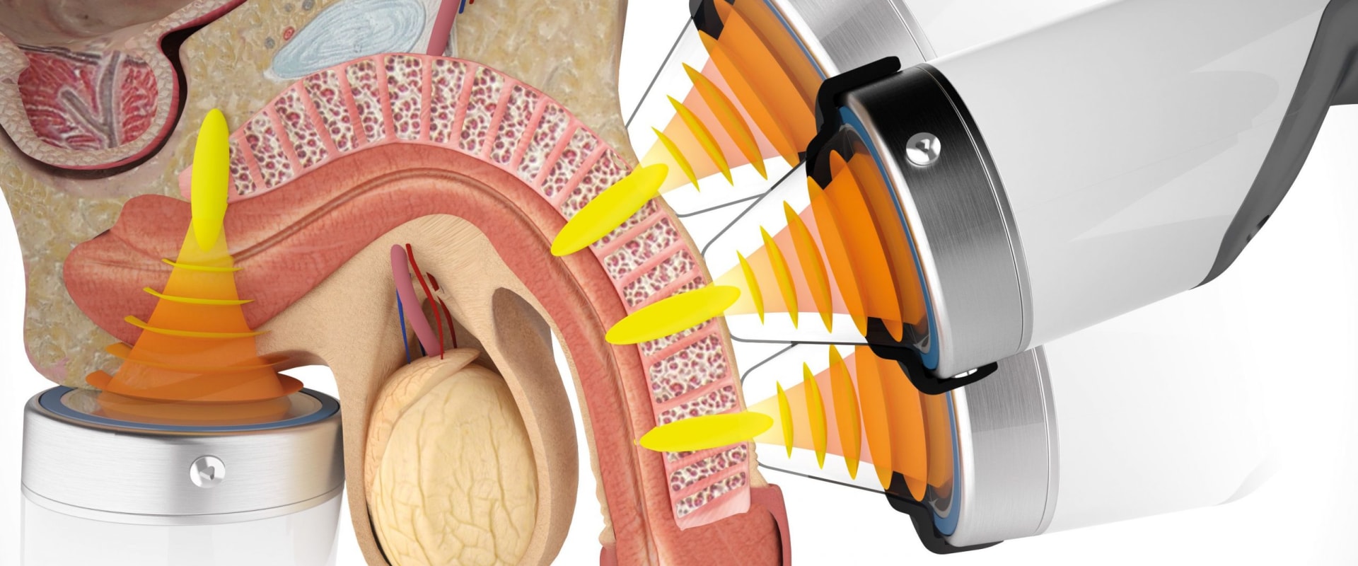 what-is-the-success-rate-of-shockwave-therapy