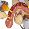Shock Wave Therapy for Erectile Dysfunction: Is It Effective?